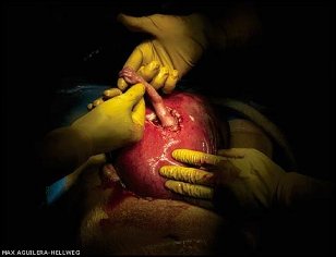 Photo of in-uterine surgery